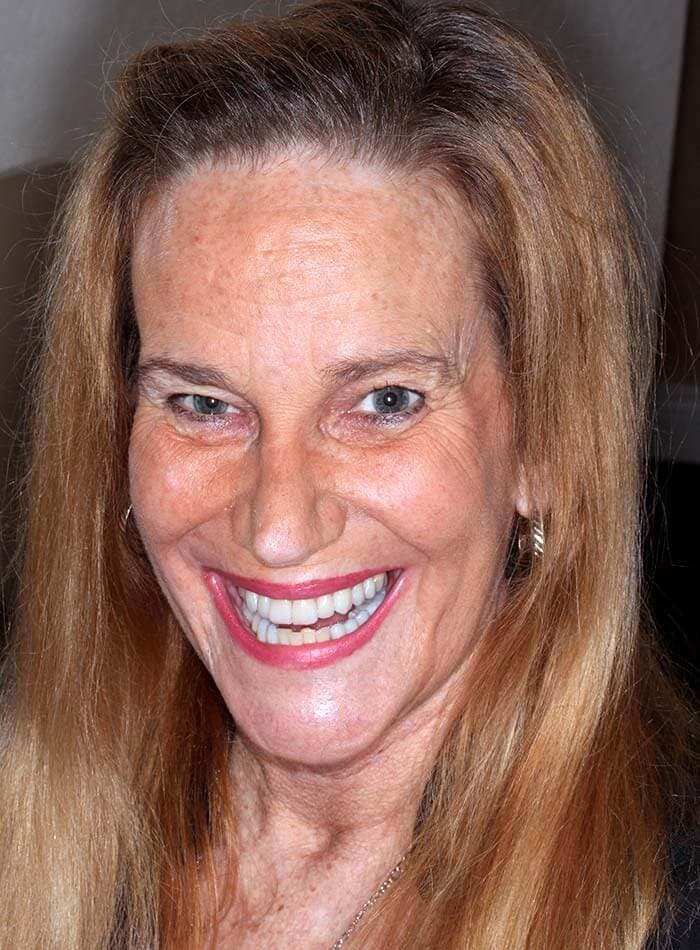 Smile after treatment, case 07