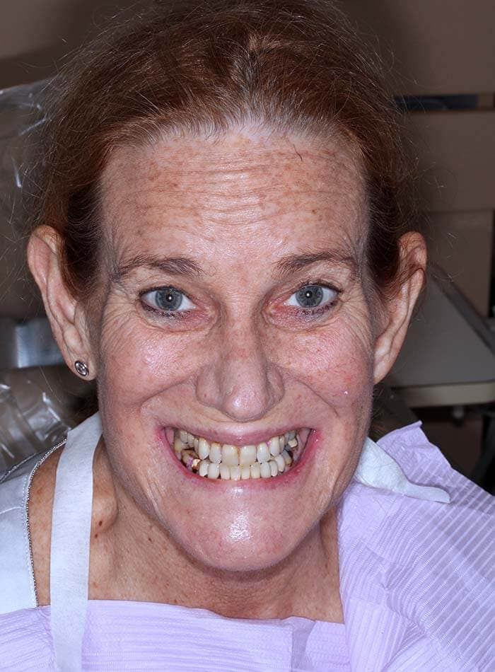 Smile before treatment, case 07