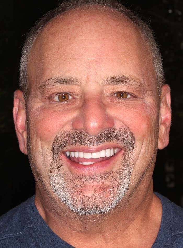After smile makeover, case 15