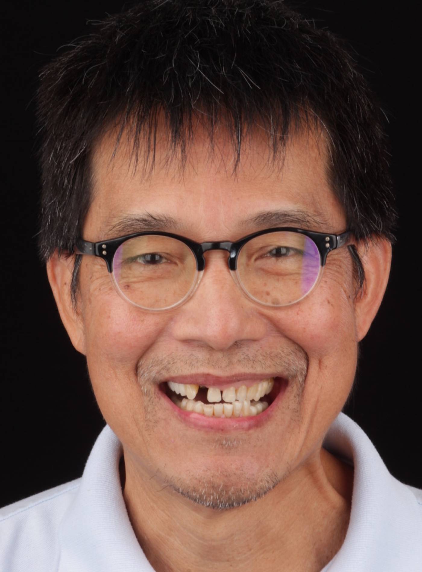 Before smile makeover