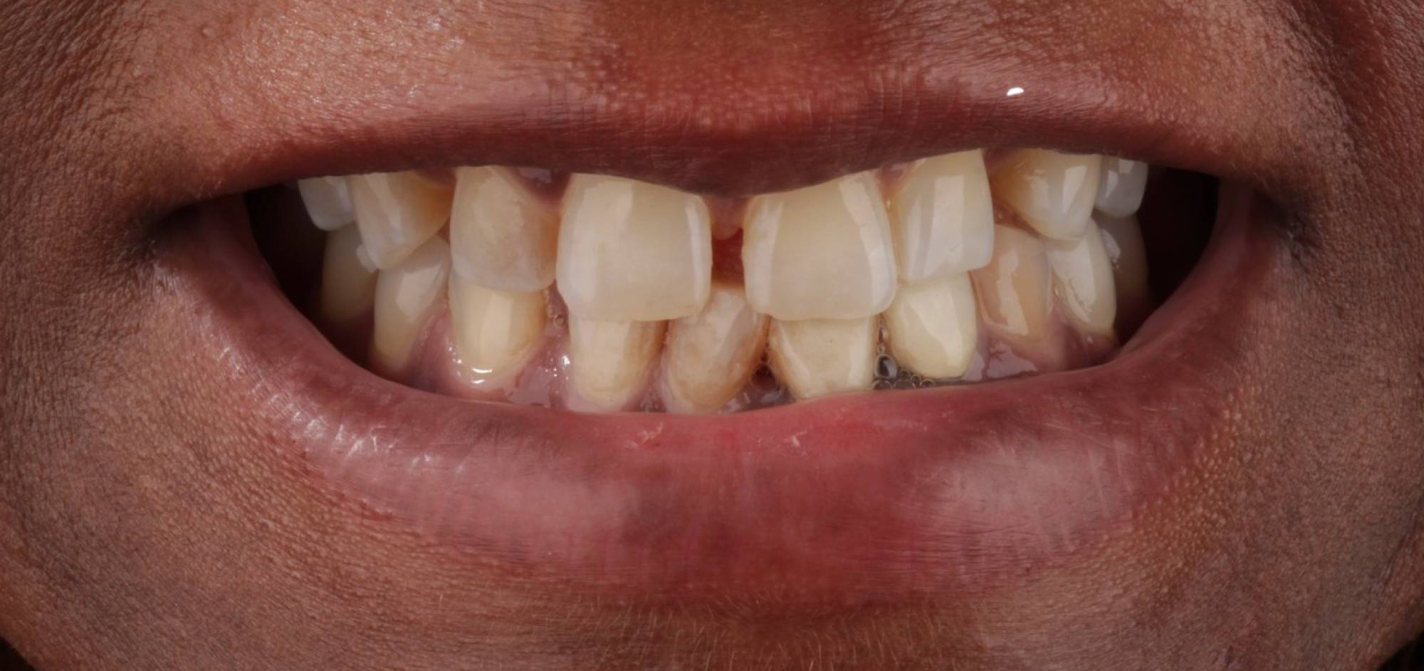 Smile before simulation
