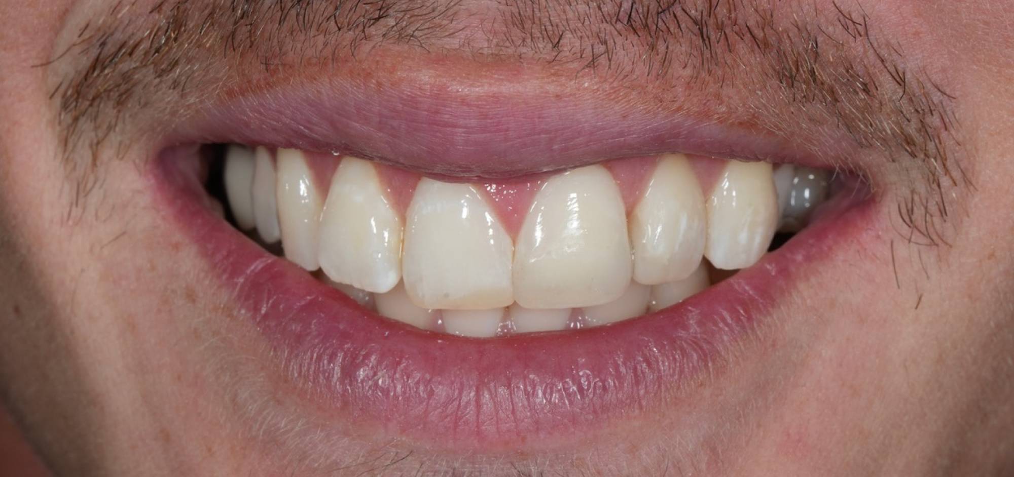 Case 42 result