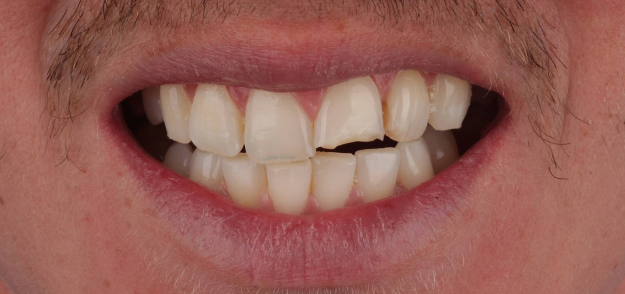 Smile before treatment, case 42