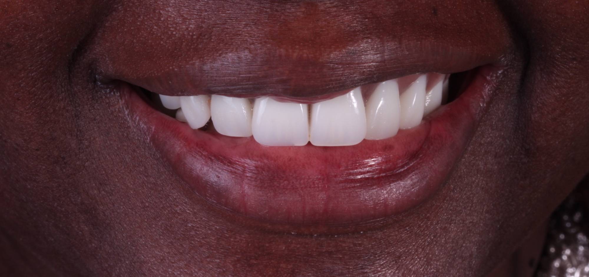 Case 45 result