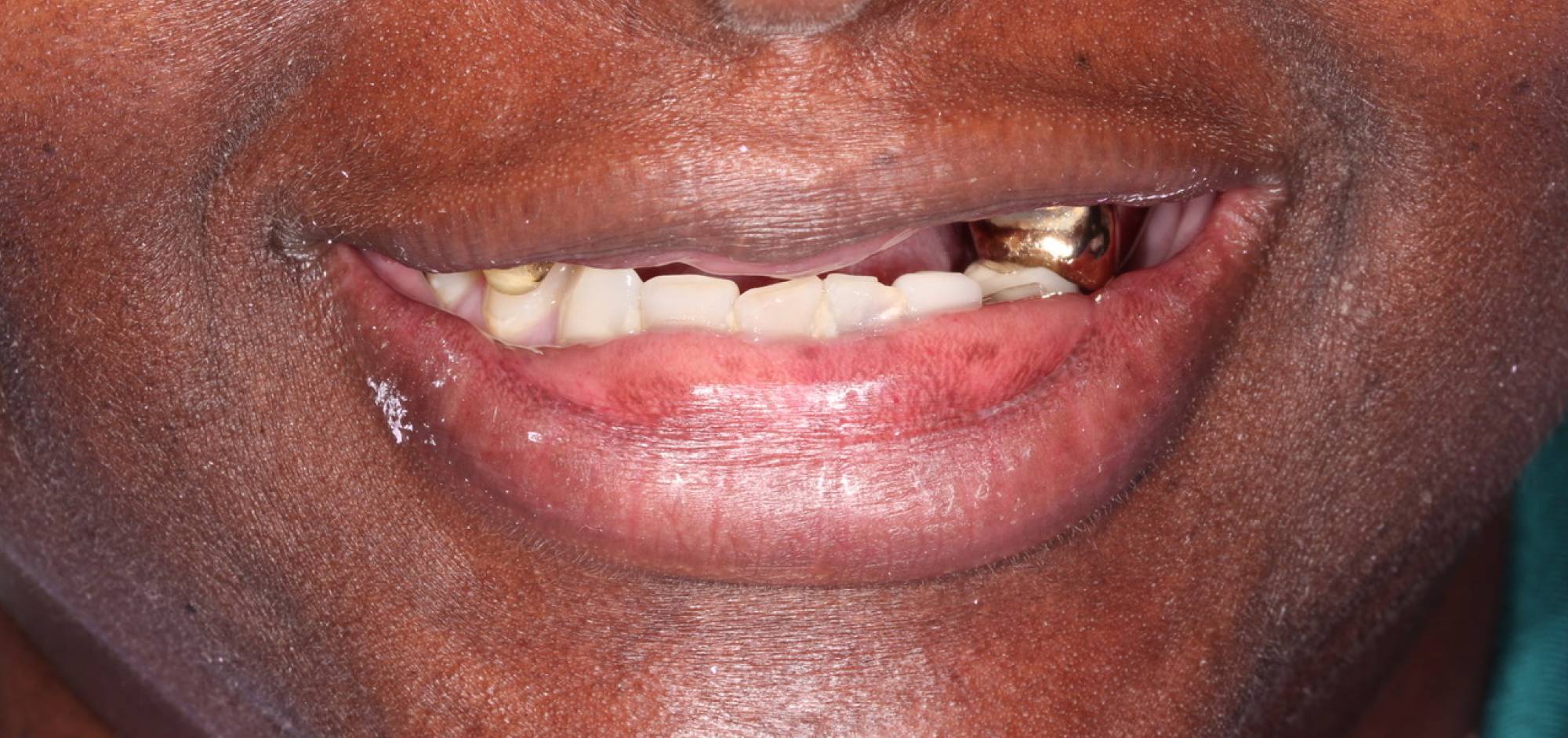 Smile before treatment, case 45