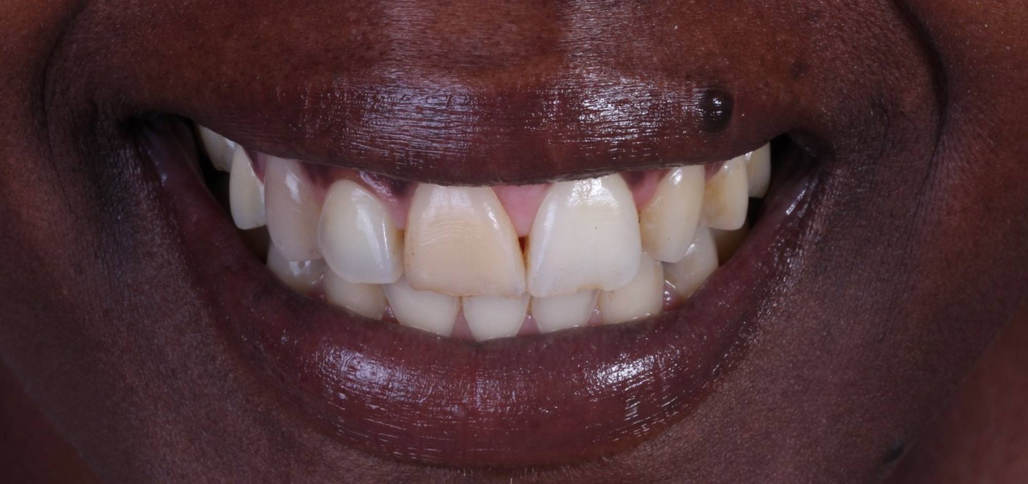 Smile before treatment, case 46